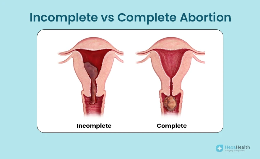 complete and incomplete abortion